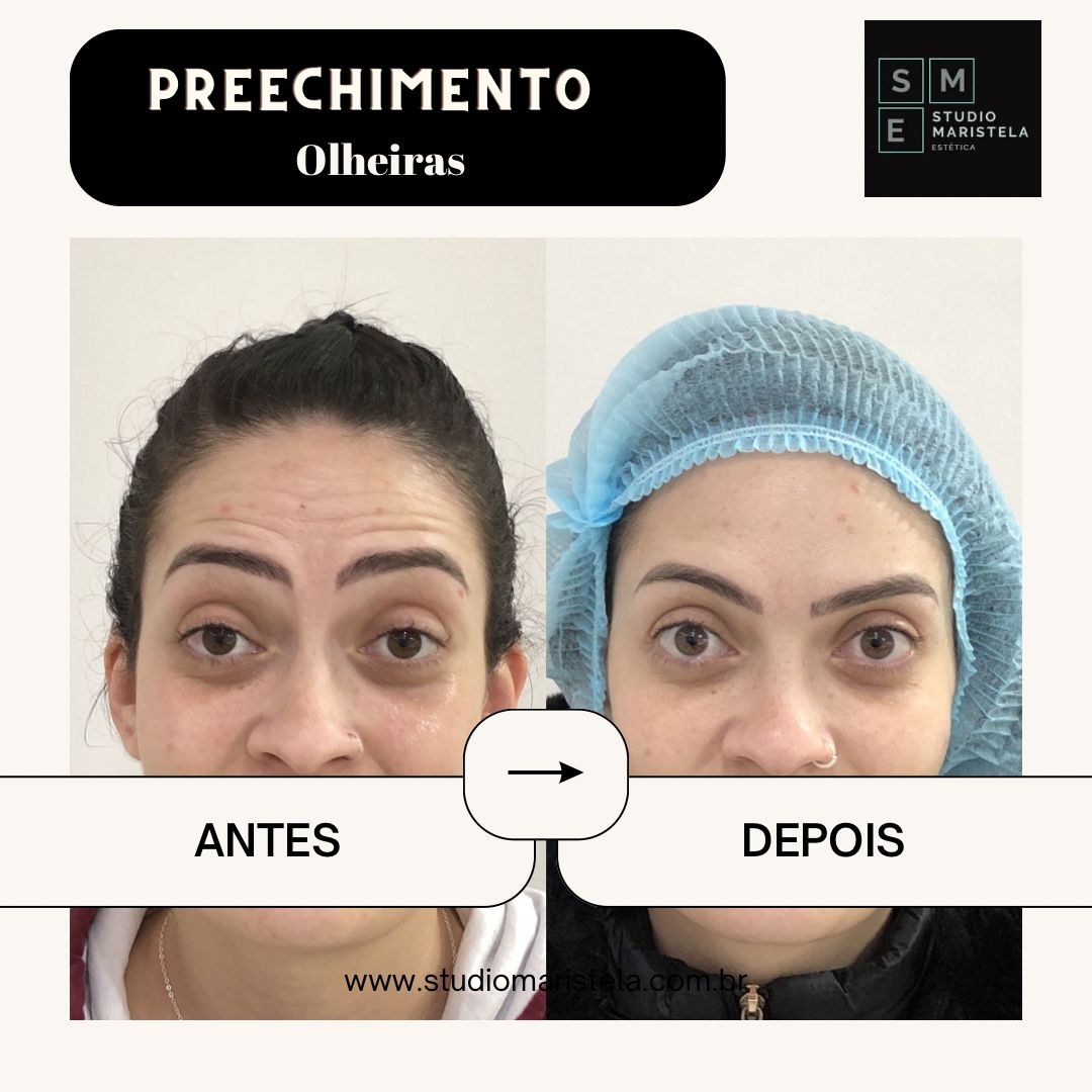 Resultado real preenchimento de olheiras - paciente 2