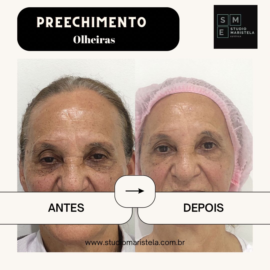 Antes e depois do preenchimento de olheiras - paciente 1