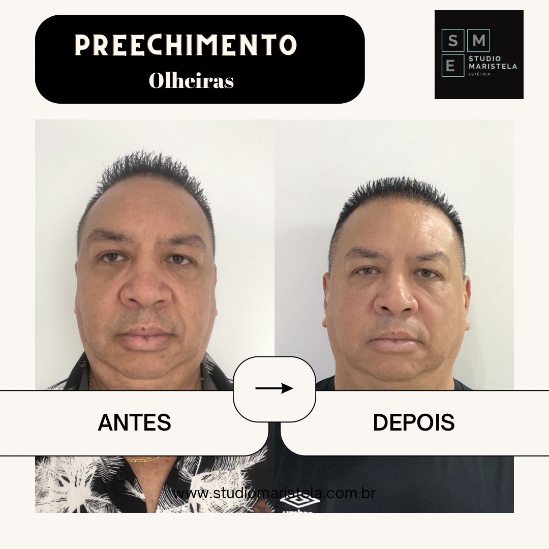 Antes e depois preenchimento ácido hialurônico - paciente 3